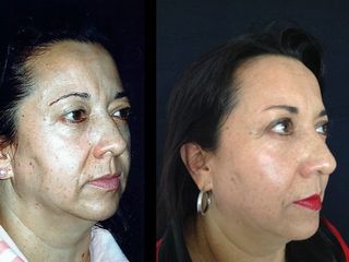 Antes y despues de rinoplastia