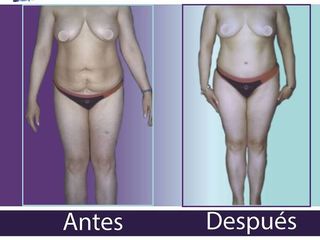 Antes y despues de abdominoplastia