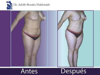 Antes y despues de abdominoplastia (1)