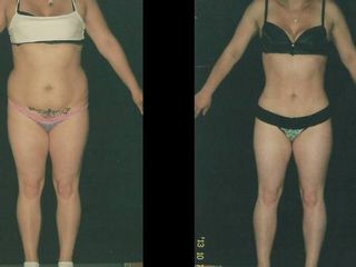 Antes y despues de abdominoplastia