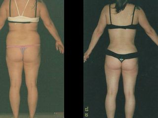 Antes y despues de abdominoplastia HD