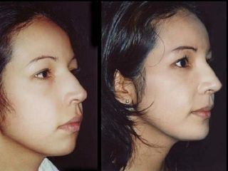 Antes y despues de rinoplastia