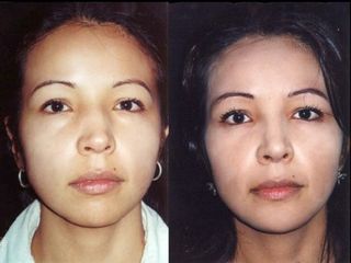 Antes y despues de rinoplastia