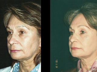 Antes y despues de rinoplastia