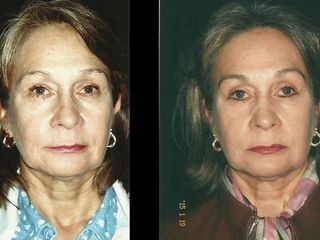 Antes y despues de rinoplastia