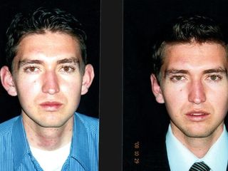 Antes y despues de otoplastia