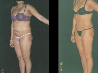 Antes y despues de abdominoplastia