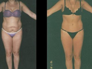 Antes y despues de abdominoplastia