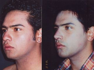 Antes y despues de rinoplastia