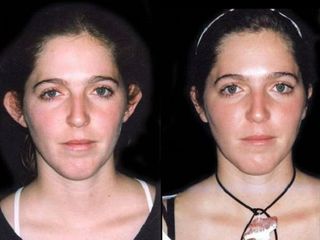 Antes y despues de rinoplastia