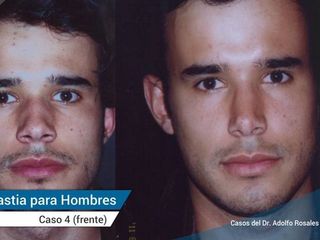 Antes y despues de rinoplastia