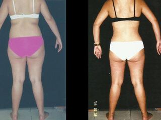 Antes y despues de abdominoplastia