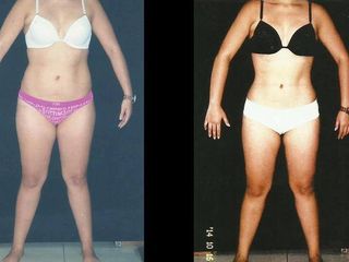 Antes y despues de abdominoplastia