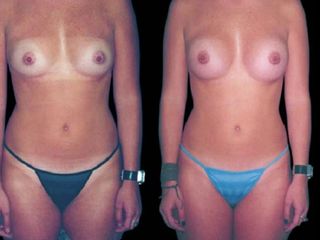 Antes y despues de mamoplastia de aumento