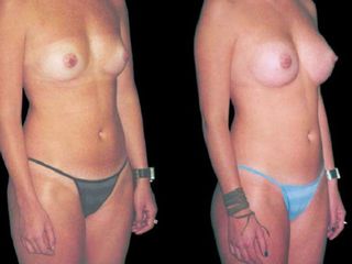 Antes y despues de mamoplastia de aumento