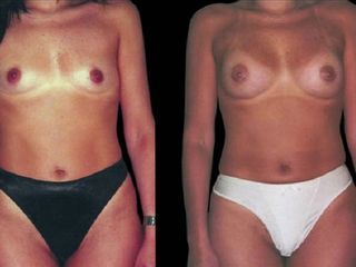 Antes y despues de mamoplastia de aumento