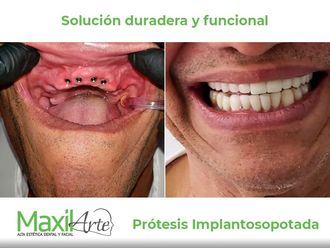 Implantes dentales - 641178