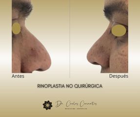 Rinomodelación  - Dr. Carlos Arturo Cervantes López