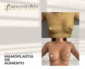 Mamoplastia de aumento - Dr. Nestor Armando Peña