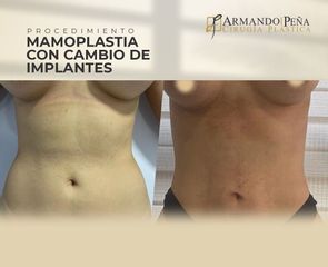 Mamoplastia de aumento - Dr. Nestor Armando Peña