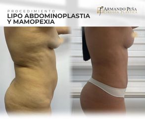 Lipoabdomindoplastia - Dr. Nestor Armando Peña