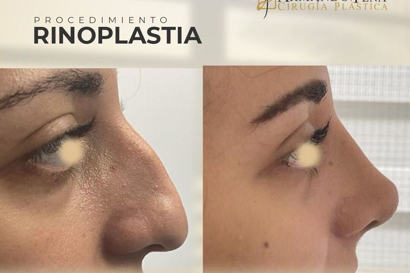 Rinoplastia antes y después - 847072