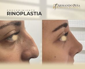 Rinoplastia - Dr. Nestor Armando Peña