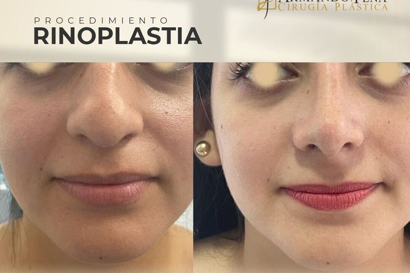 Rinoplastia antes y después - 847073