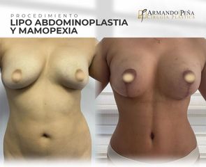 Lipoabdomindoplastia - Dr. Nestor Armando Peña