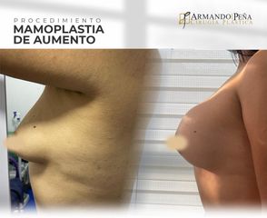 Mamoplastia de aumento - Dr. Nestor Armando Peña