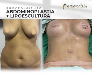 Abdominoplastia - Dr. Nestor Armando Peña