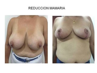 Reducción Mamaria