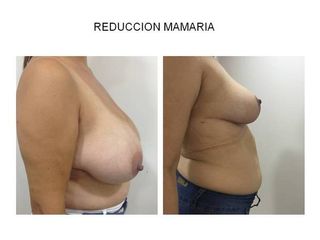 Reducción Mamaria