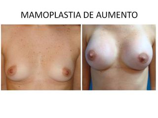 Mamoplastía de Aumento