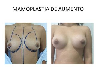 Mamoplastía de aumento