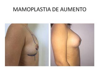 Mamoplastía de Aumento