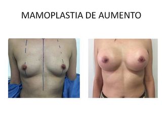 Mamoplastía de Aumento