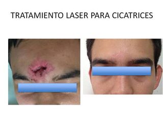 Tratamiento laser para Cicatrices