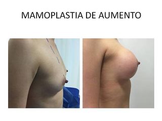 Mamoplastía de Aumento