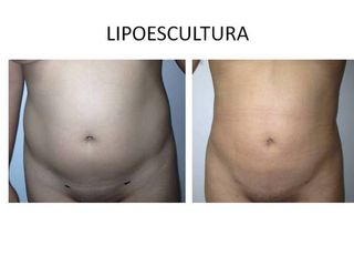Lipoescultura