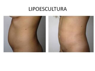 Lipoescultura