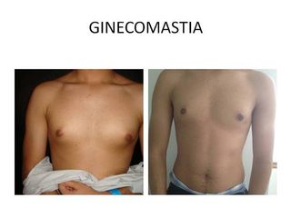Ginecomastia