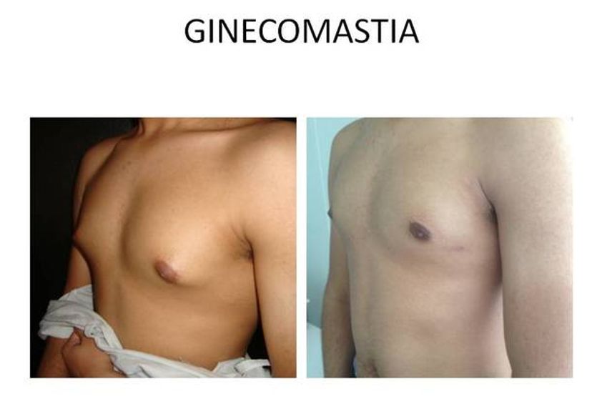 Ginecomastia antes y después - 526398