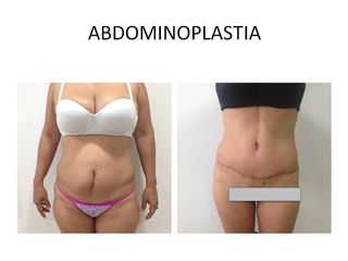 Abdominoplastía 