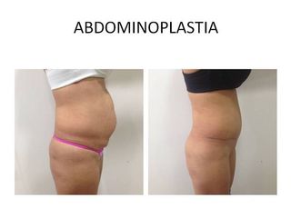 Abdominoplastía