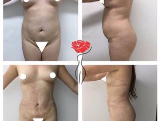Lipoescultura