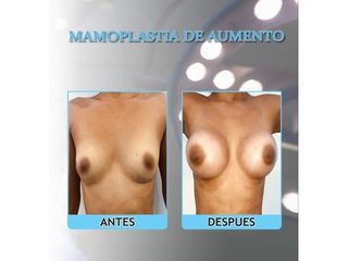 Mamoplastia de aumento 