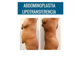 Abdominoplastia