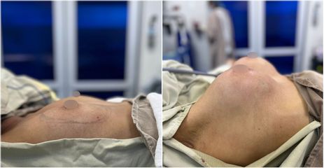 Mamoplastia de aumento - Dr. Alejandro Ruiz Cortés