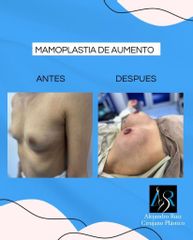 Mamoplastia de aumento - Dr. Alejandro Ruiz Cortés